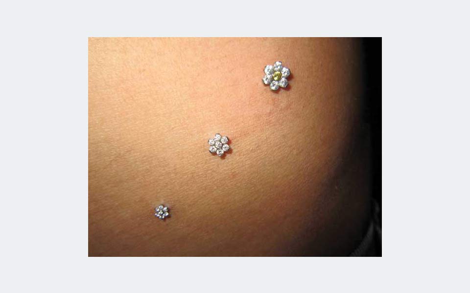 Microdermal Klinik Tizio